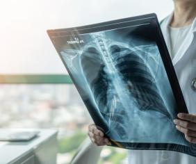 doktor diagnostikuje pacientovo pľúcne ochorenie z röntgenovej snímky